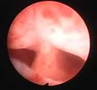 Hysteroscopic Resection Uterine Septum